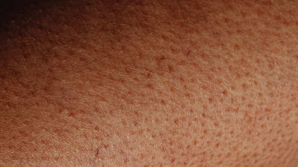 HS — deeper than skin